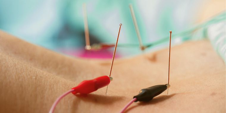 L'électropuncture - L'électricité pour soigner les douleurs