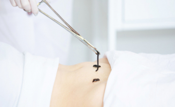 L'hirudothérapie - L'utilisation des sangsues comme anticoagulant naturel