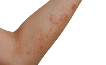 Les huiles essentielles contre le zona